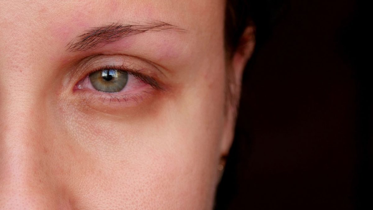 Bolinha no olho: terçol ou calázio? - Hospital de Olhos do Paraná